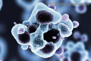 Il Cancro al Seno Metastatico (Stadio 4) Può Essere Curato? Speranze e Strategie per Vincere la Battaglia