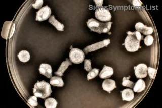 ¿Es Curable el Melanoma en Etapa Temprana? Descubre Esperanza y Soluciones Efectivas