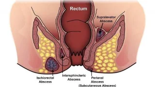 Anus stinkt: oorzaken, symptomen en effectieve oplossingen