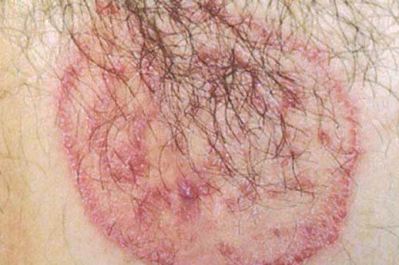 A micose na área genital masculina é perigosa? Medicamentos para tratar micose rapidamente