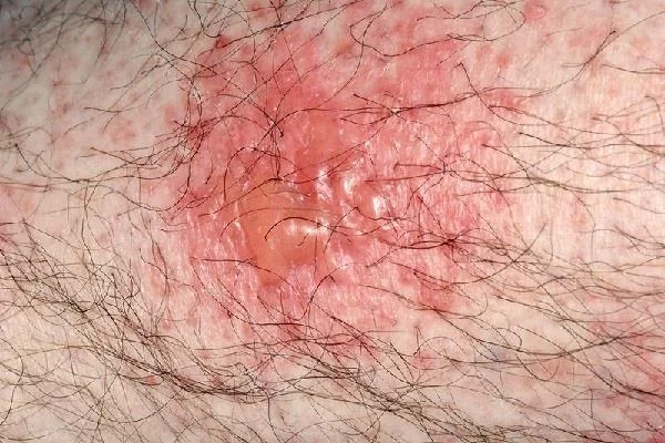 A micose na área genital masculina é perigosa? Medicamentos para tratar micose rapidamente