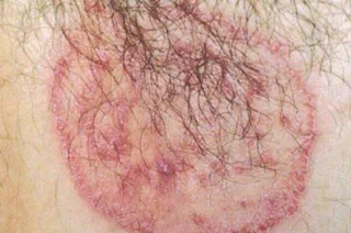 A micose na área genital masculina é perigosa? Descubra os melhores medicamentos para tratar micose rapidamente