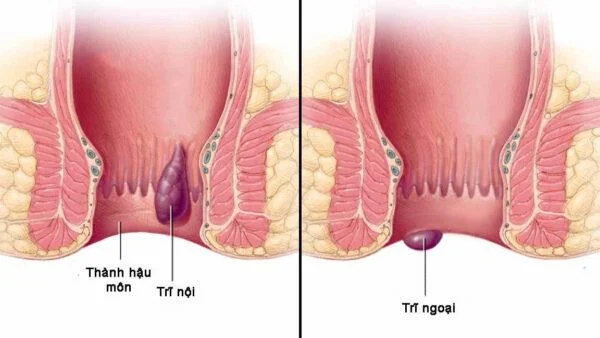 Bagaimana akupresur mengobati wasir?