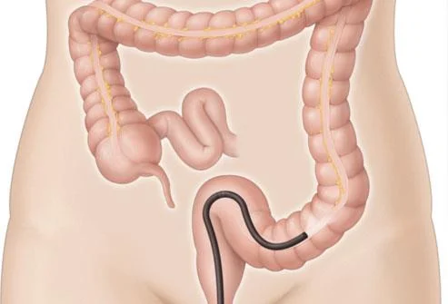 Sindrom ulkus dubur terisolasi: tanda, penyebab, diagnosis dan pengobatan