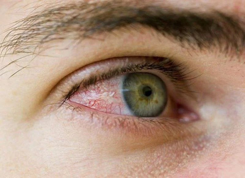 Unguento per gli occhi Tobradex: usi, utilizzo e a cosa devi prestare attenzione