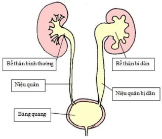 Hidronefrosis: Apa yang perlu Anda ketahui