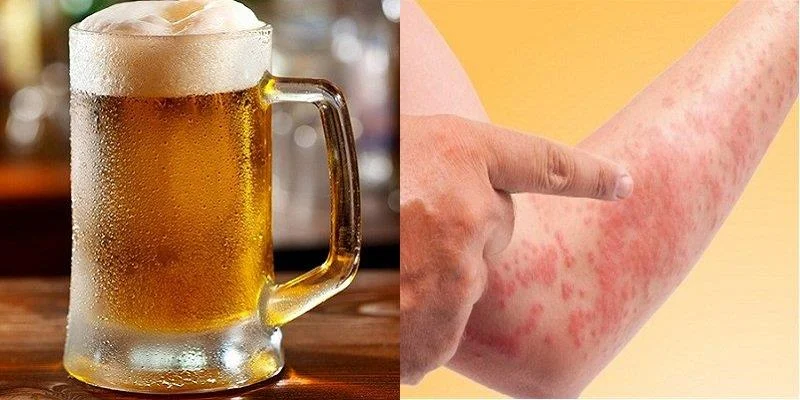 Cosa fare se si è allergici alla birra? Sintomi e prevenzione