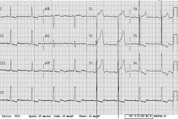 ECG-resultaten bij LVH