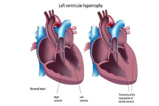 Linkerventrikelhypertrofie: Oorzaken, Symptomen, Diagnose en Behandeling | Alles Wat U Moet Weten