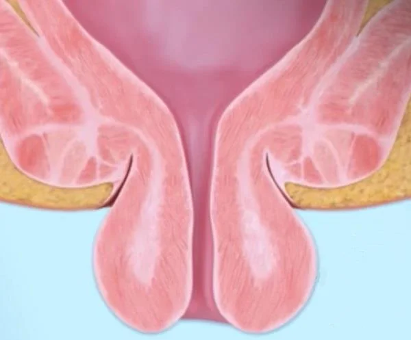 Sindrom ulkus dubur terisolasi: tanda, penyebab, diagnosis dan pengobatan