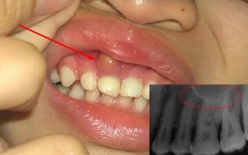 Wat is een kaakcyste? Symptomen, diagnose en behandeling