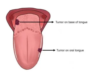 Tongkanker: is het te genezen?