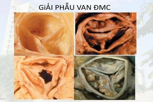 Aortaklepstenose en LVH
