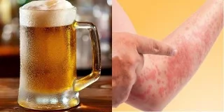 Cosa fare se si è allergici alla birra? Sintomi, Trattamenti e Prevenzione
