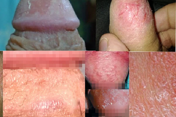 Prevenzione prepuzio screpolato: igiene corretta