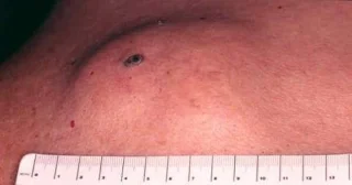 Epidermoid Kist: Deride En Sık Görülen Kist Türü ve Tedavi Yöntemleri