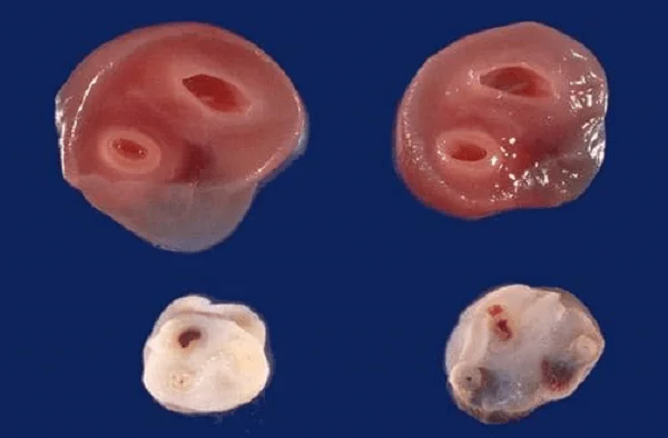 Tali pusat arteri tunggal: definisi, etiologi, prognosis?