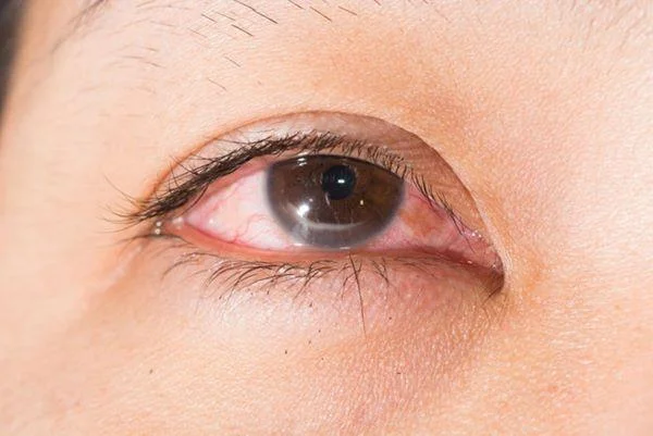 ¿Qué son las gotas para los ojos de Tobrex?  Usos, uso y notas al usar