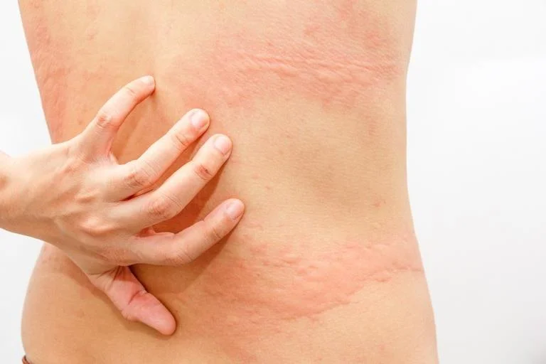 Carbimazol: Usos, usos e precauções